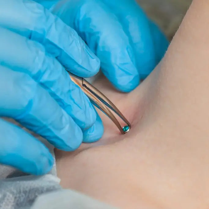 Dermal Removal